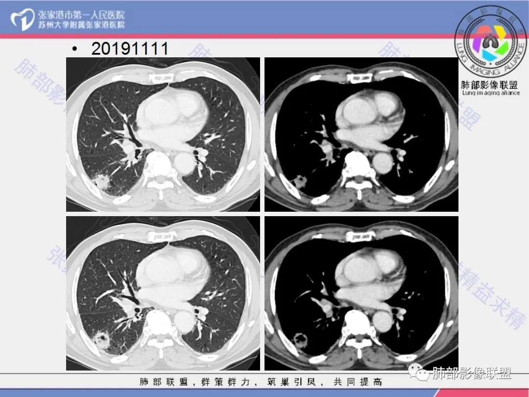影像PPT - 【病例】 这例肺部空洞性病变影像分析应该读一读-10 影像PPT - 【病例】 这例肺部空洞性病变影像分析应该读一读-10