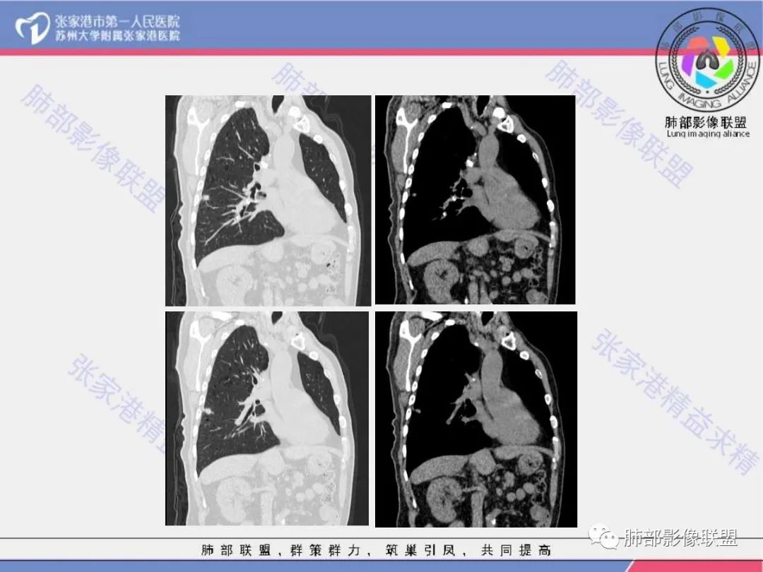 影像PPT - 【病例】 这例肺部空洞性病变影像分析应该读一读-8 影像PPT - 【病例】 这例肺部空洞性病变影像分析应该读一读-8
