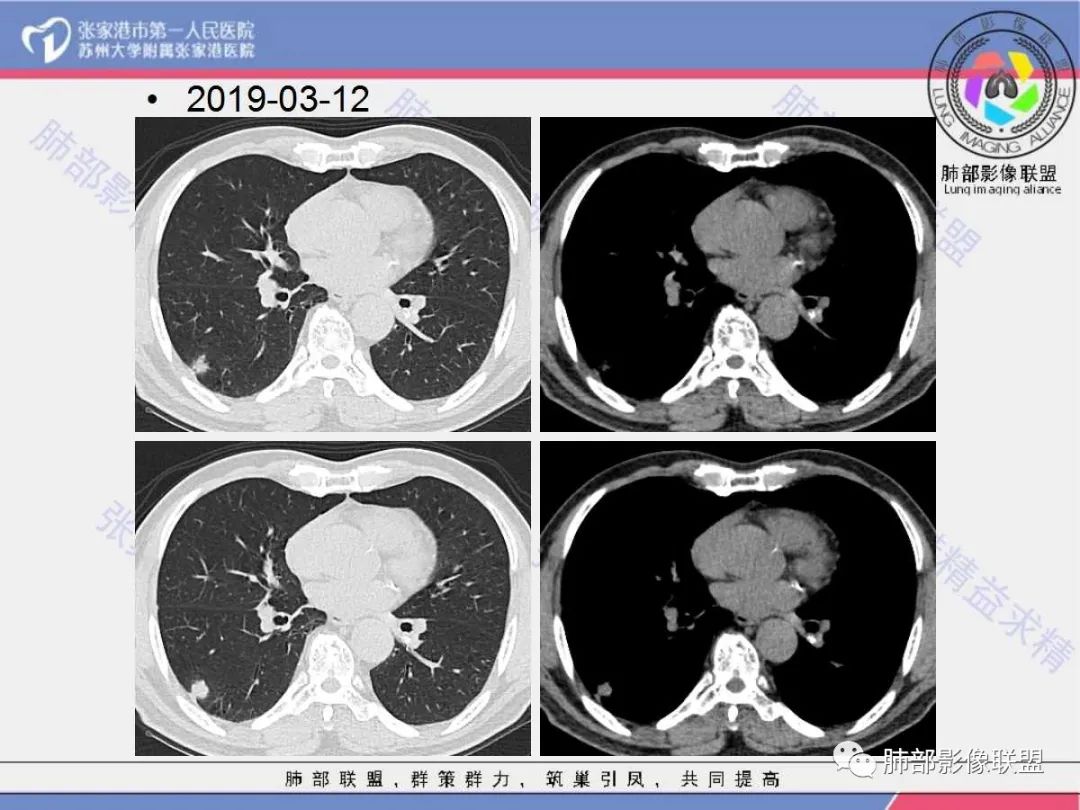 影像PPT - 【病例】 这例肺部空洞性病变影像分析应该读一读-5 影像PPT - 【病例】 这例肺部空洞性病变影像分析应该读一读-5