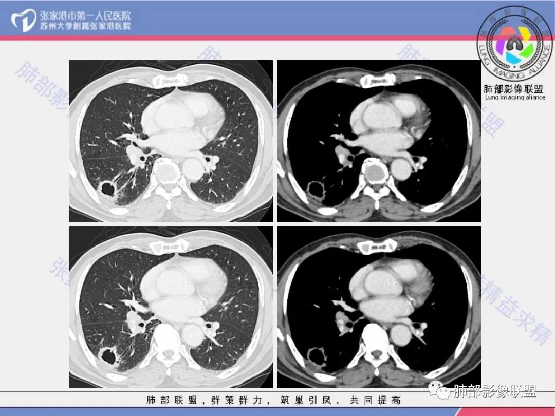 影像PPT - 【病例】 这例肺部空洞性病变影像分析应该读一读-11 影像PPT - 【病例】 这例肺部空洞性病变影像分析应该读一读-11