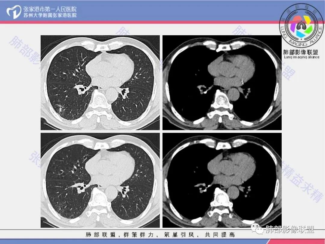 影像PPT - 【病例】 这例肺部空洞性病变影像分析应该读一读-7 影像PPT - 【病例】 这例肺部空洞性病变影像分析应该读一读-7