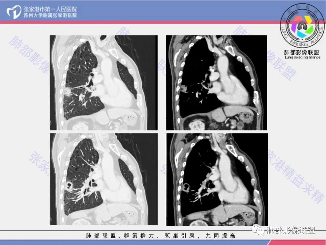 影像PPT - 【病例】 这例肺部空洞性病变影像分析应该读一读-15 影像PPT - 【病例】 这例肺部空洞性病变影像分析应该读一读-15