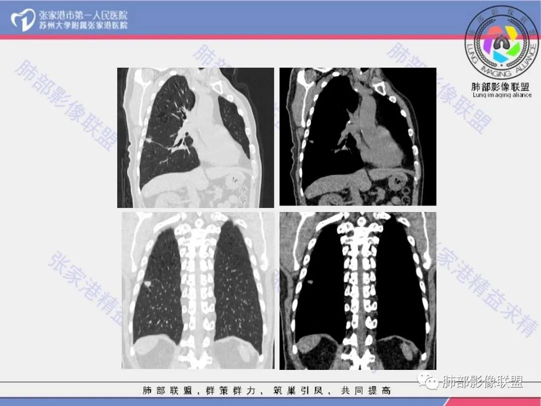 影像PPT - 【病例】 这例肺部空洞性病变影像分析应该读一读-9 影像PPT - 【病例】 这例肺部空洞性病变影像分析应该读一读-9