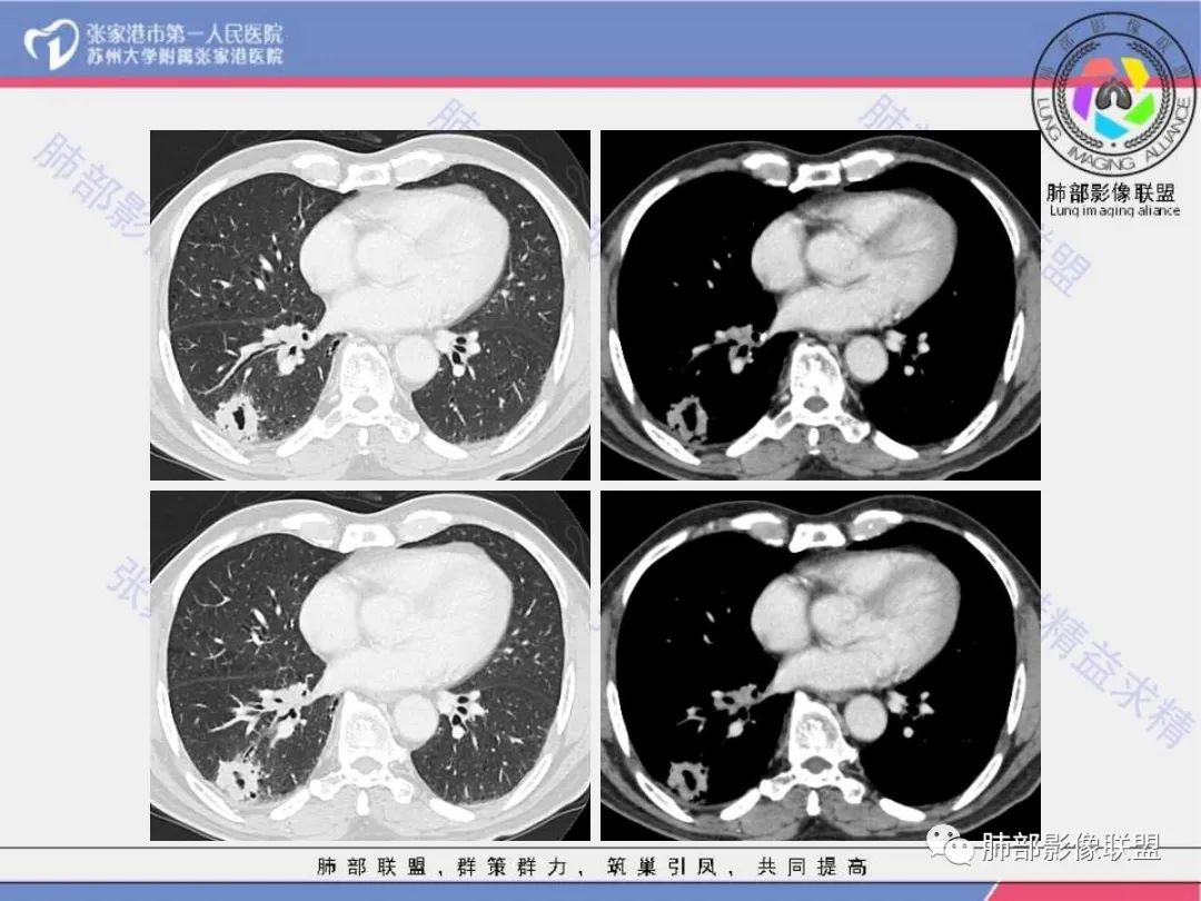 影像PPT - 【病例】 这例肺部空洞性病变影像分析应该读一读-13 影像PPT - 【病例】 这例肺部空洞性病变影像分析应该读一读-13