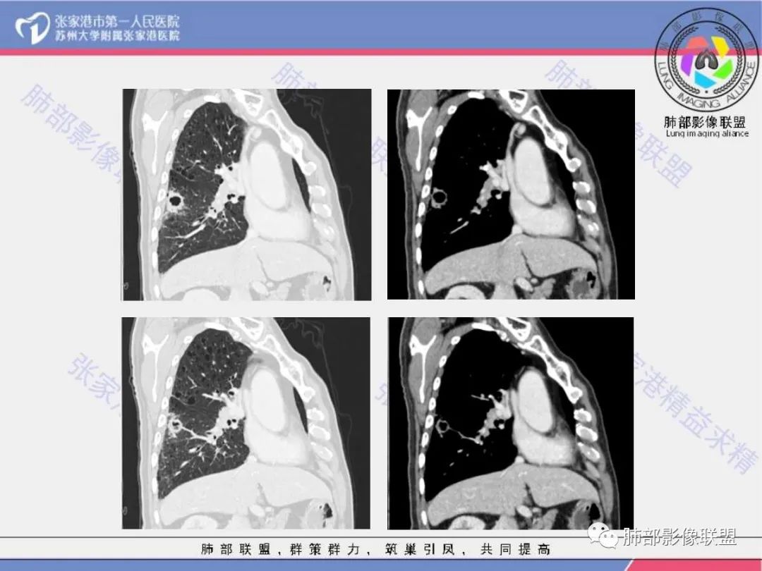 影像PPT - 【病例】 这例肺部空洞性病变影像分析应该读一读-17 影像PPT - 【病例】 这例肺部空洞性病变影像分析应该读一读-17