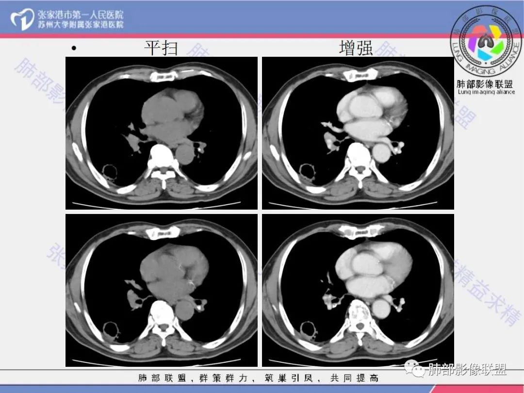 影像PPT - 【病例】 这例肺部空洞性病变影像分析应该读一读-18 影像PPT - 【病例】 这例肺部空洞性病变影像分析应该读一读-18