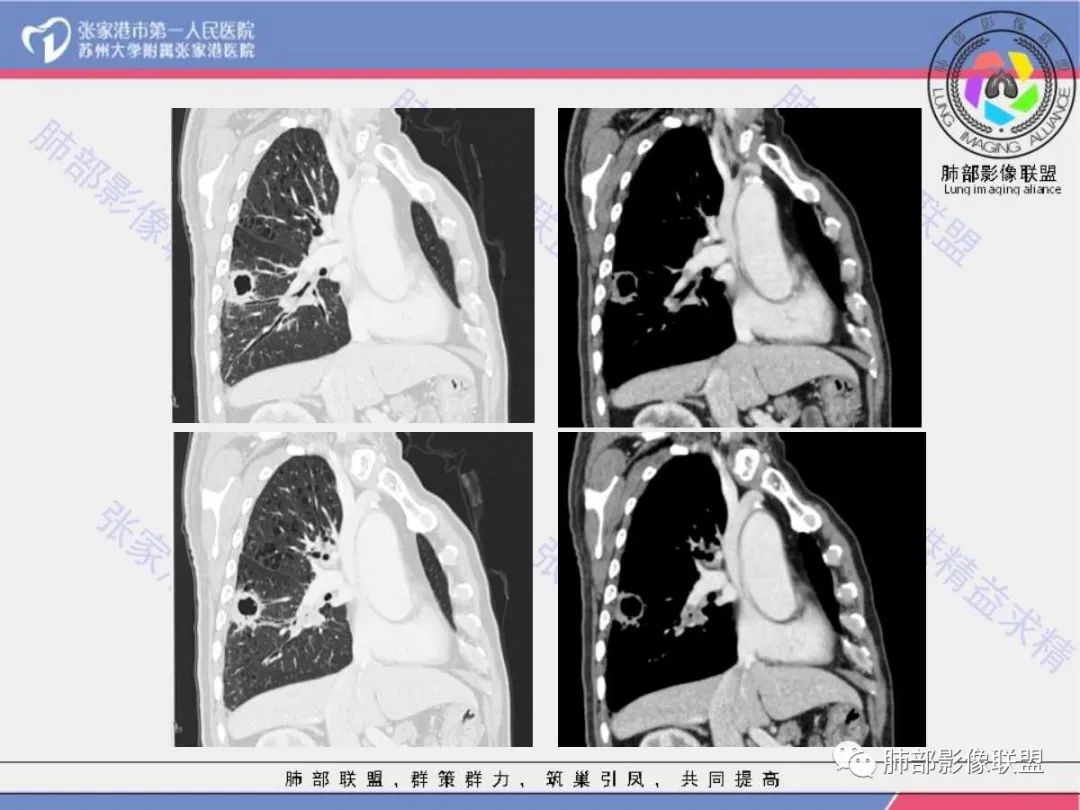 影像PPT - 【病例】 这例肺部空洞性病变影像分析应该读一读-16 影像PPT - 【病例】 这例肺部空洞性病变影像分析应该读一读-16