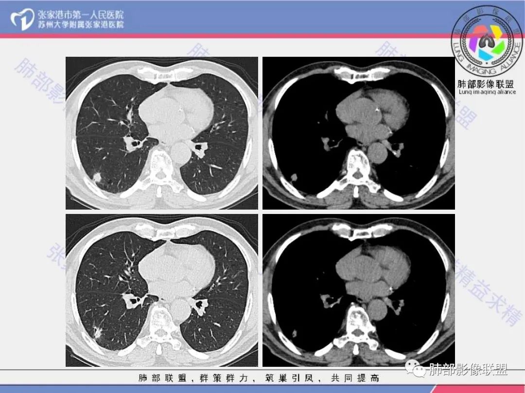 影像PPT - 【病例】 这例肺部空洞性病变影像分析应该读一读-6 影像PPT - 【病例】 这例肺部空洞性病变影像分析应该读一读-6