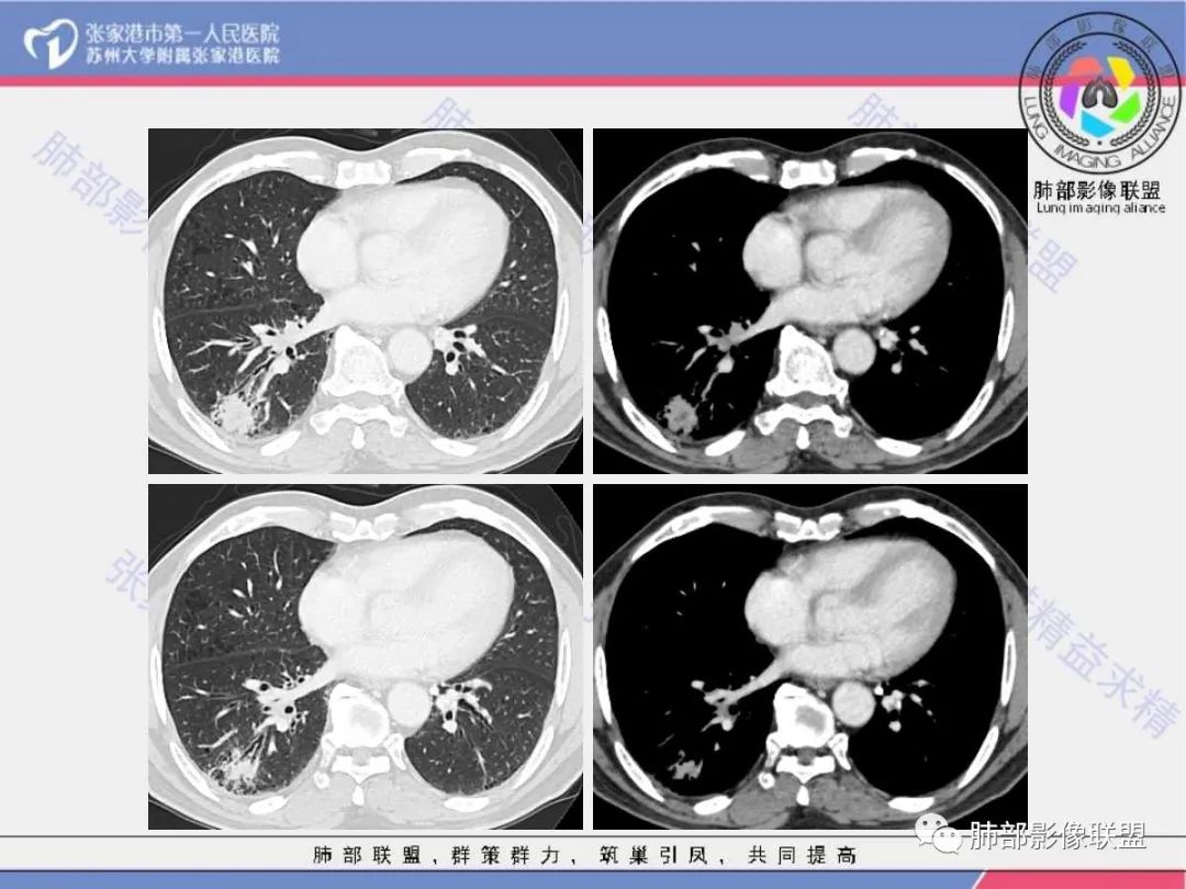 影像PPT - 【病例】 这例肺部空洞性病变影像分析应该读一读-14 影像PPT - 【病例】 这例肺部空洞性病变影像分析应该读一读-14
