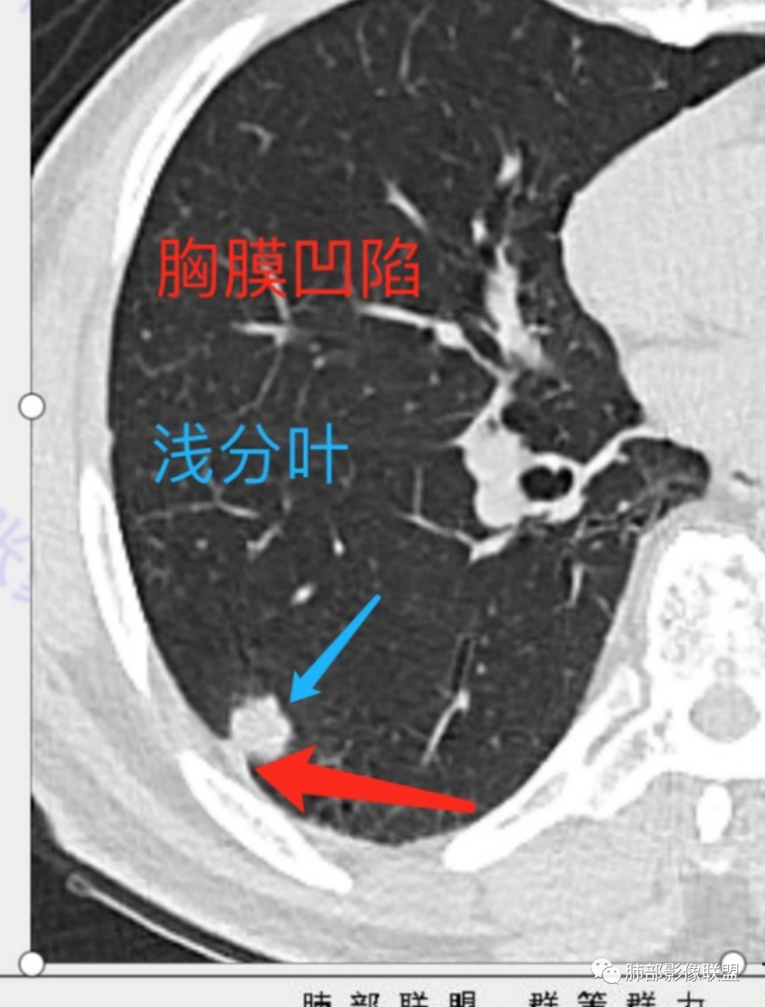 影像PPT - 【病例】 这例肺部空洞性病变影像分析应该读一读-22 影像PPT - 【病例】 这例肺部空洞性病变影像分析应该读一读-22