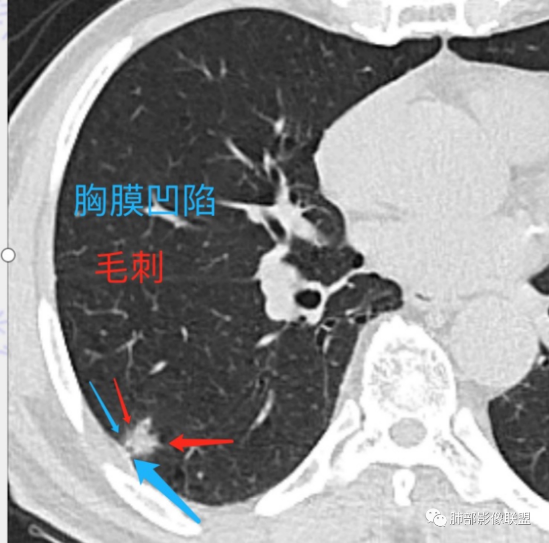 影像PPT - 【病例】 这例肺部空洞性病变影像分析应该读一读-21 影像PPT - 【病例】 这例肺部空洞性病变影像分析应该读一读-21