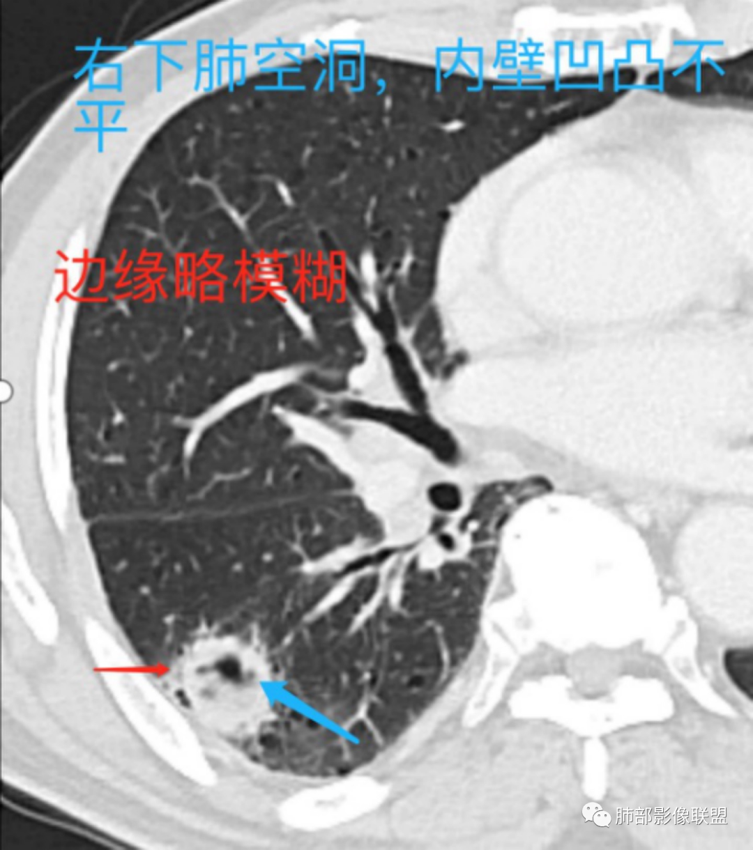 影像PPT - 【病例】 这例肺部空洞性病变影像分析应该读一读-25 影像PPT - 【病例】 这例肺部空洞性病变影像分析应该读一读-25