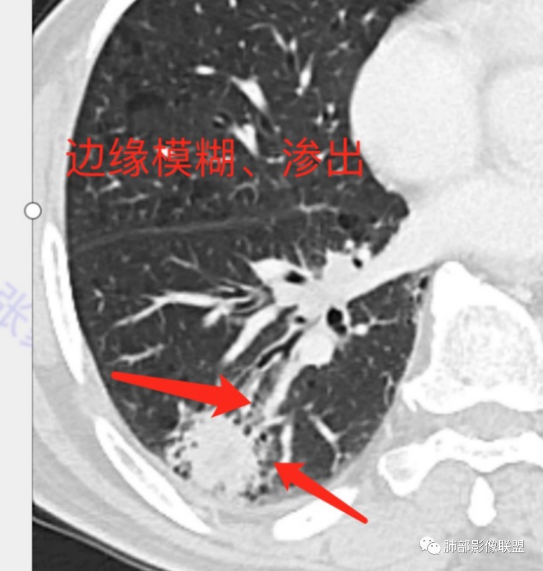 影像PPT - 【病例】 这例肺部空洞性病变影像分析应该读一读-28 影像PPT - 【病例】 这例肺部空洞性病变影像分析应该读一读-28