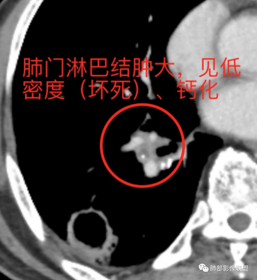 影像PPT - 【病例】 这例肺部空洞性病变影像分析应该读一读-29 影像PPT - 【病例】 这例肺部空洞性病变影像分析应该读一读-29