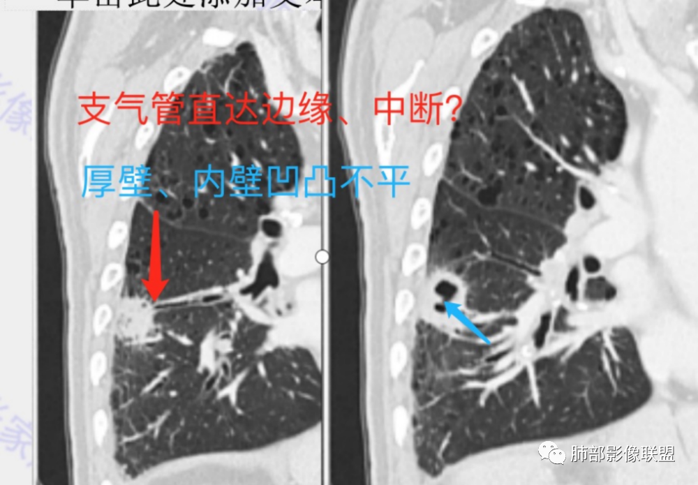 影像PPT - 【病例】 这例肺部空洞性病变影像分析应该读一读-30 影像PPT - 【病例】 这例肺部空洞性病变影像分析应该读一读-30