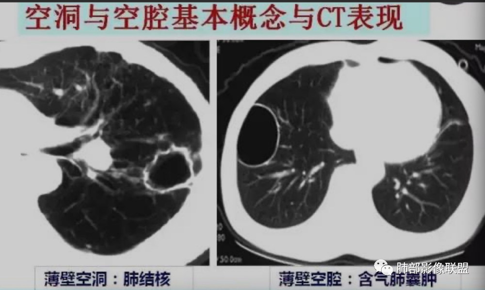 影像PPT - 【病例】 这例肺部空洞性病变影像分析应该读一读-31 影像PPT - 【病例】 这例肺部空洞性病变影像分析应该读一读-31