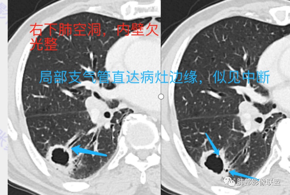 影像PPT - 【病例】 这例肺部空洞性病变影像分析应该读一读-32 影像PPT - 【病例】 这例肺部空洞性病变影像分析应该读一读-32