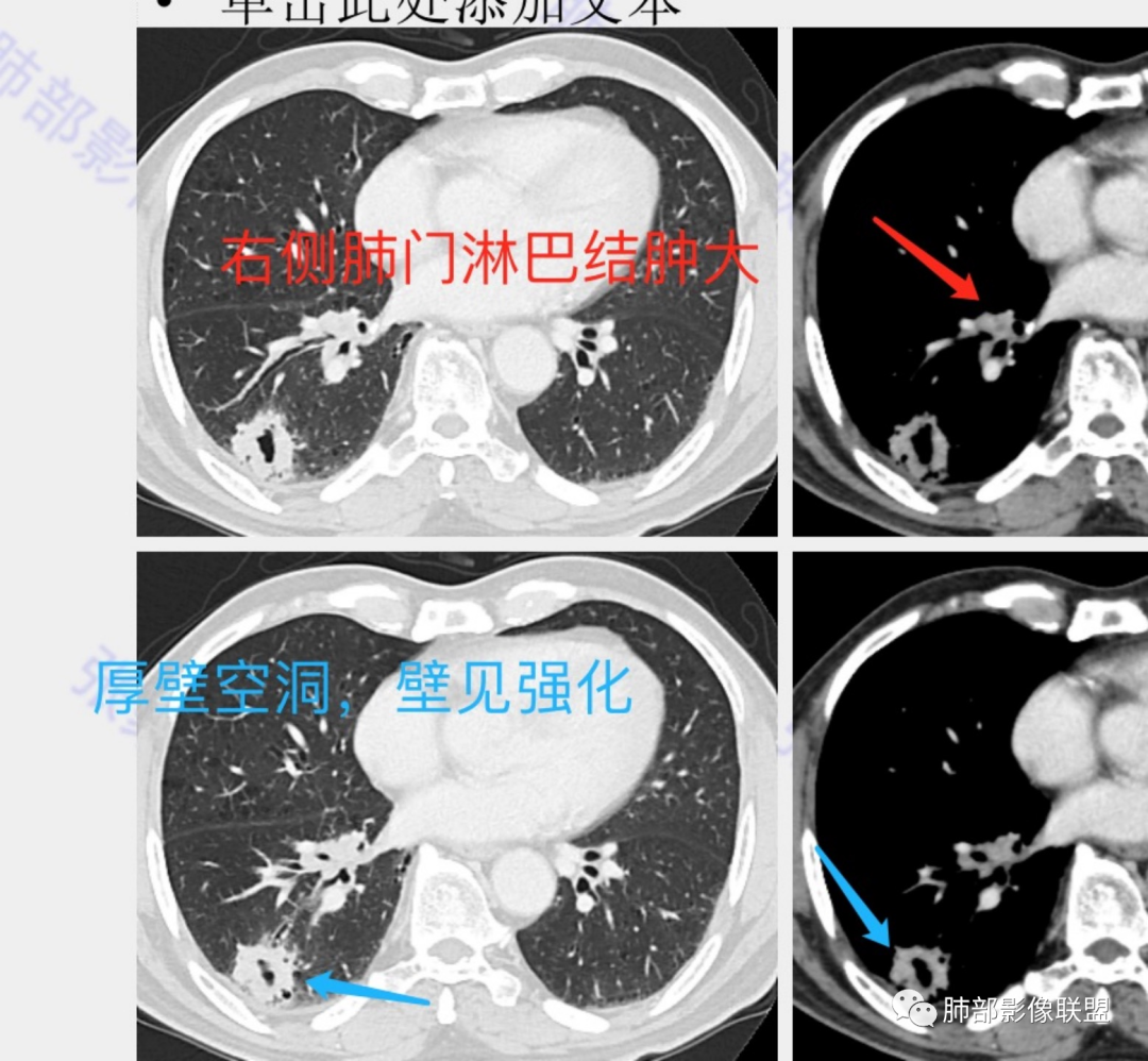 影像PPT - 【病例】 这例肺部空洞性病变影像分析应该读一读-34 影像PPT - 【病例】 这例肺部空洞性病变影像分析应该读一读-34
