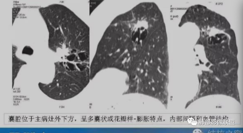 影像PPT - 【病例】 这例肺部空洞性病变影像分析应该读一读-39 影像PPT - 【病例】 这例肺部空洞性病变影像分析应该读一读-39