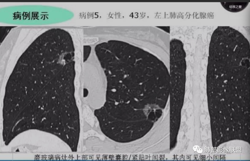 影像PPT - 【病例】 这例肺部空洞性病变影像分析应该读一读-40 影像PPT - 【病例】 这例肺部空洞性病变影像分析应该读一读-40