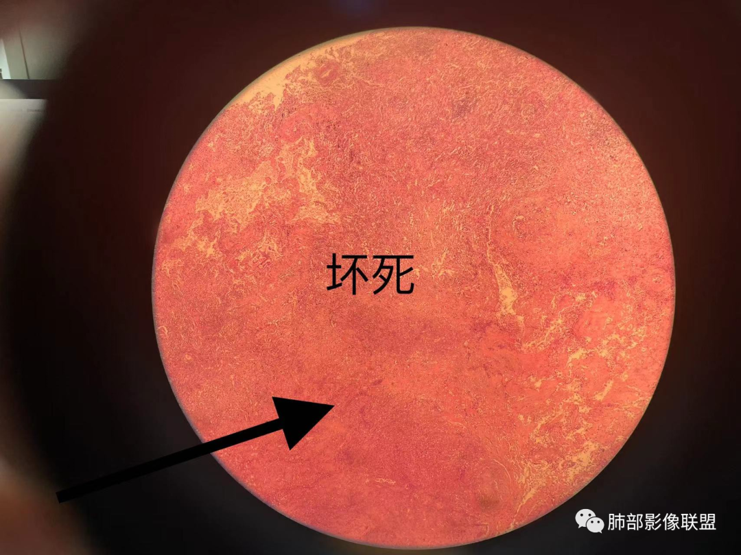 影像PPT - 【病例】 这例肺部空洞性病变影像分析应该读一读-51 影像PPT - 【病例】 这例肺部空洞性病变影像分析应该读一读-51