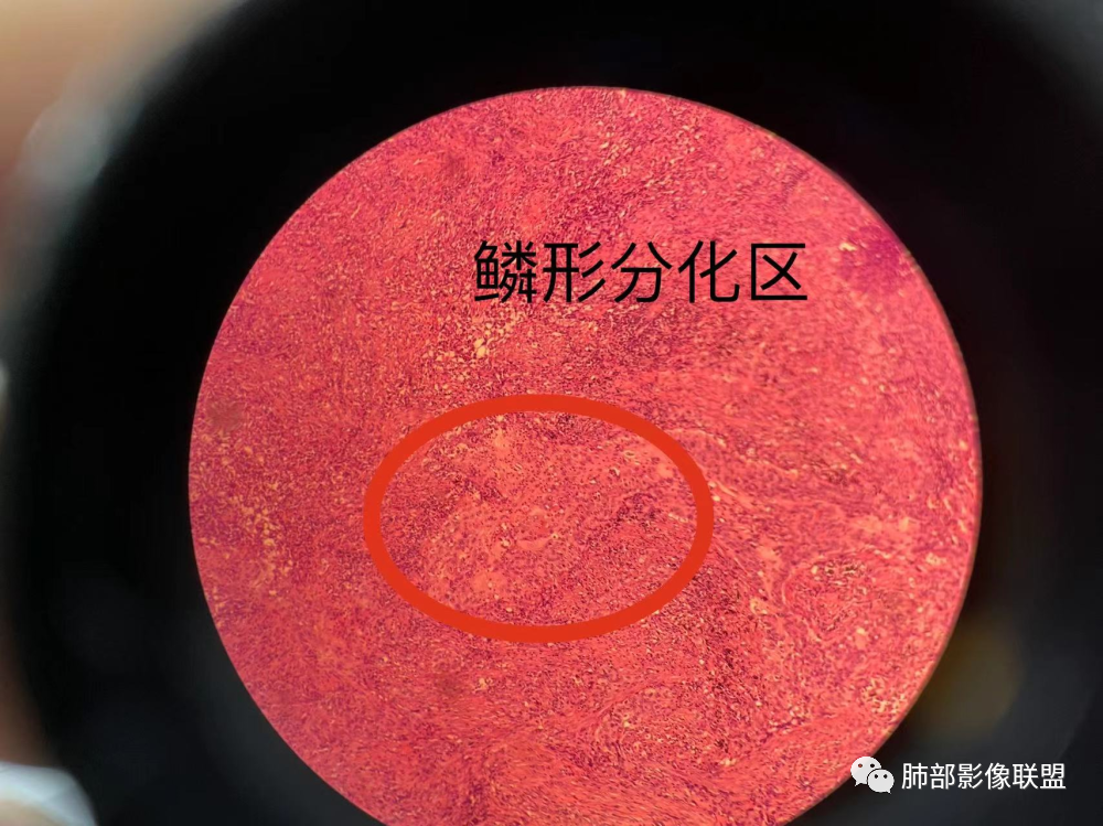 影像PPT - 【病例】 这例肺部空洞性病变影像分析应该读一读-53 影像PPT - 【病例】 这例肺部空洞性病变影像分析应该读一读-53