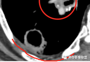 影像PPT - 【病例】 这例肺部空洞性病变影像分析应该读一读-65 影像PPT - 【病例】 这例肺部空洞性病变影像分析应该读一读-65