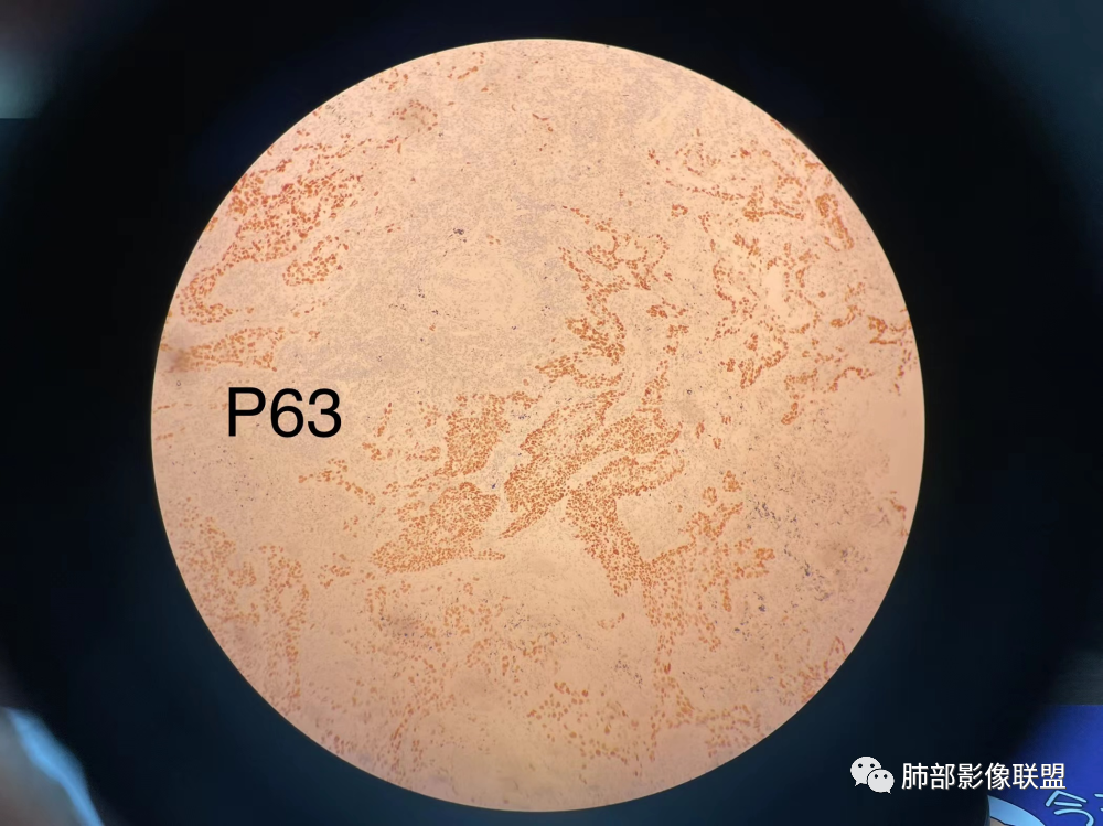 影像PPT - 【病例】 这例肺部空洞性病变影像分析应该读一读-58 影像PPT - 【病例】 这例肺部空洞性病变影像分析应该读一读-58