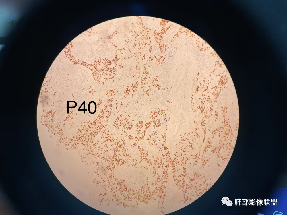 影像PPT - 【病例】 这例肺部空洞性病变影像分析应该读一读-63 影像PPT - 【病例】 这例肺部空洞性病变影像分析应该读一读-63