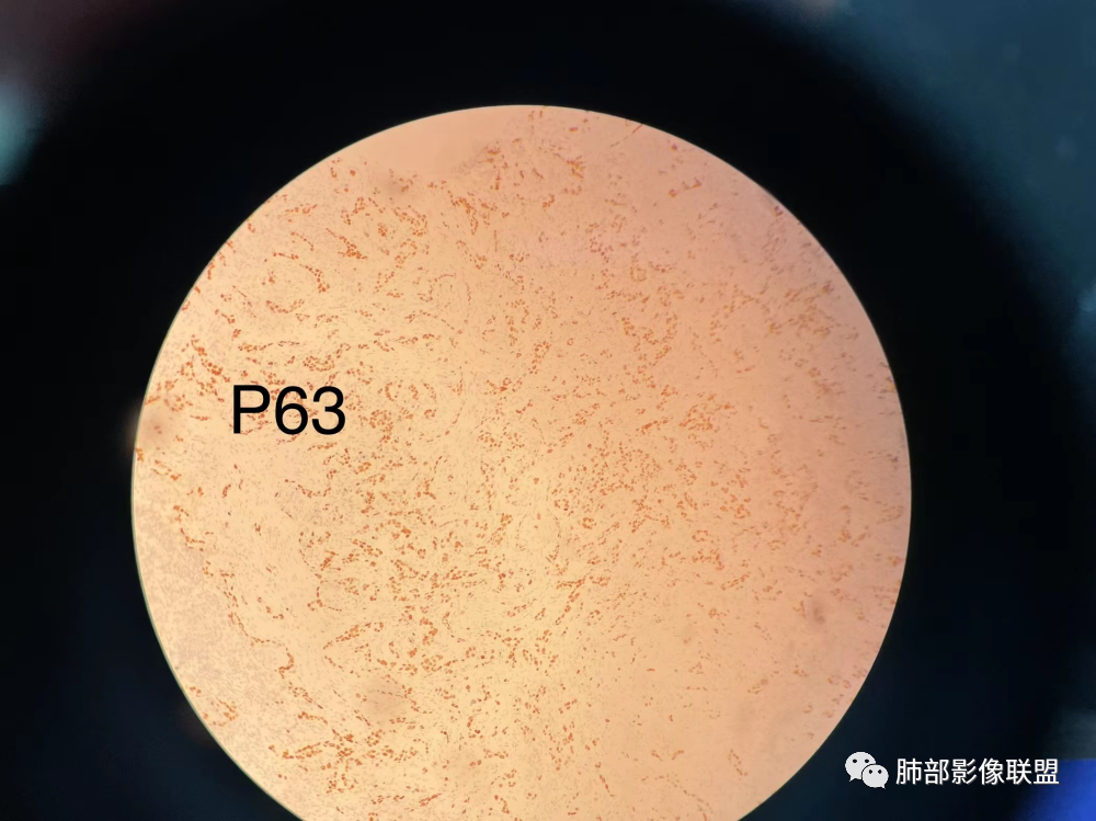 影像PPT - 【病例】 这例肺部空洞性病变影像分析应该读一读-59 影像PPT - 【病例】 这例肺部空洞性病变影像分析应该读一读-59