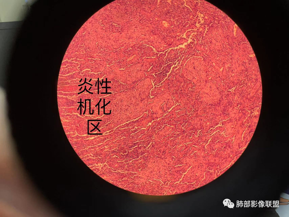 影像PPT - 【病例】 这例肺部空洞性病变影像分析应该读一读-61 影像PPT - 【病例】 这例肺部空洞性病变影像分析应该读一读-61