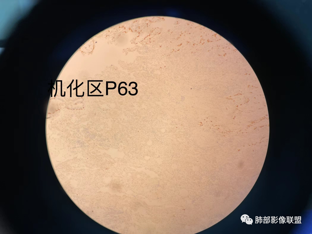影像PPT - 【病例】 这例肺部空洞性病变影像分析应该读一读-62 影像PPT - 【病例】 这例肺部空洞性病变影像分析应该读一读-62