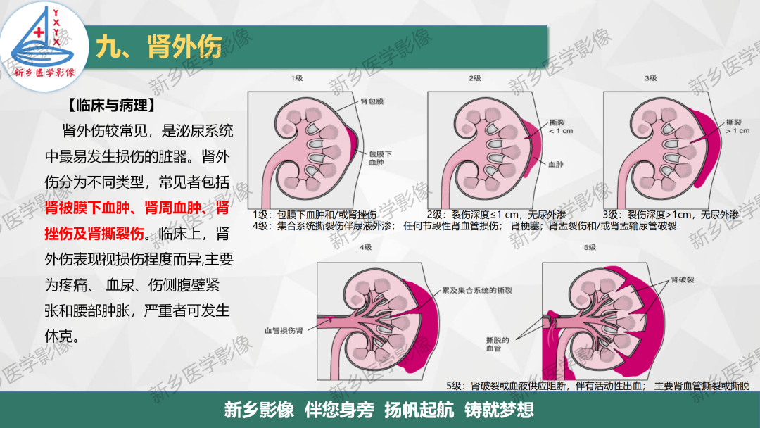 影像PPT - 【PPT】输尿管及膀胱肿瘤分期及肾脏外伤分级-18