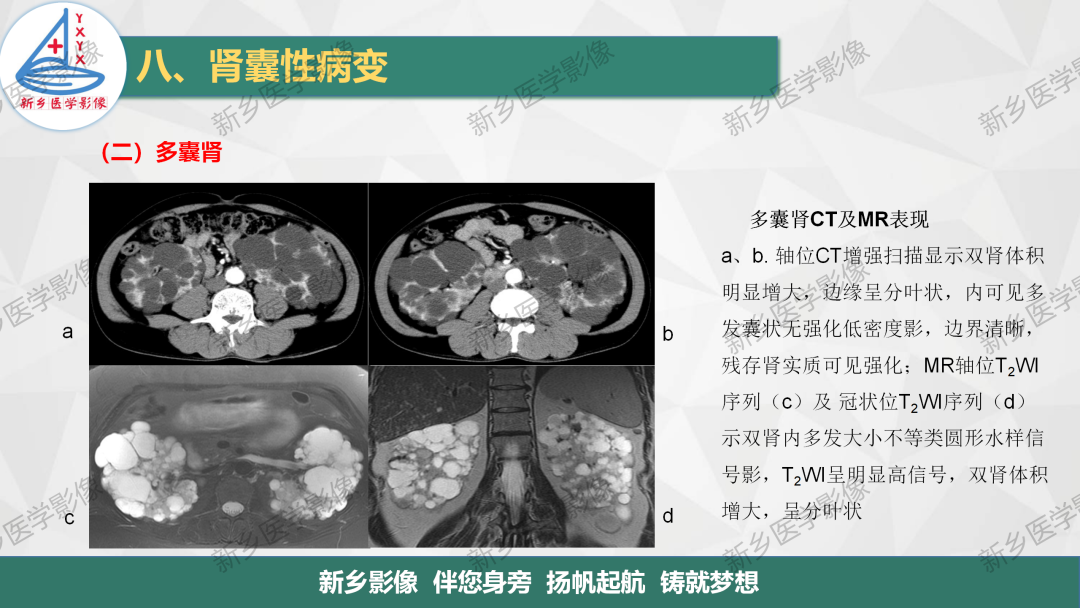 影像PPT - 【PPT】输尿管及膀胱肿瘤分期及肾脏外伤分级-17