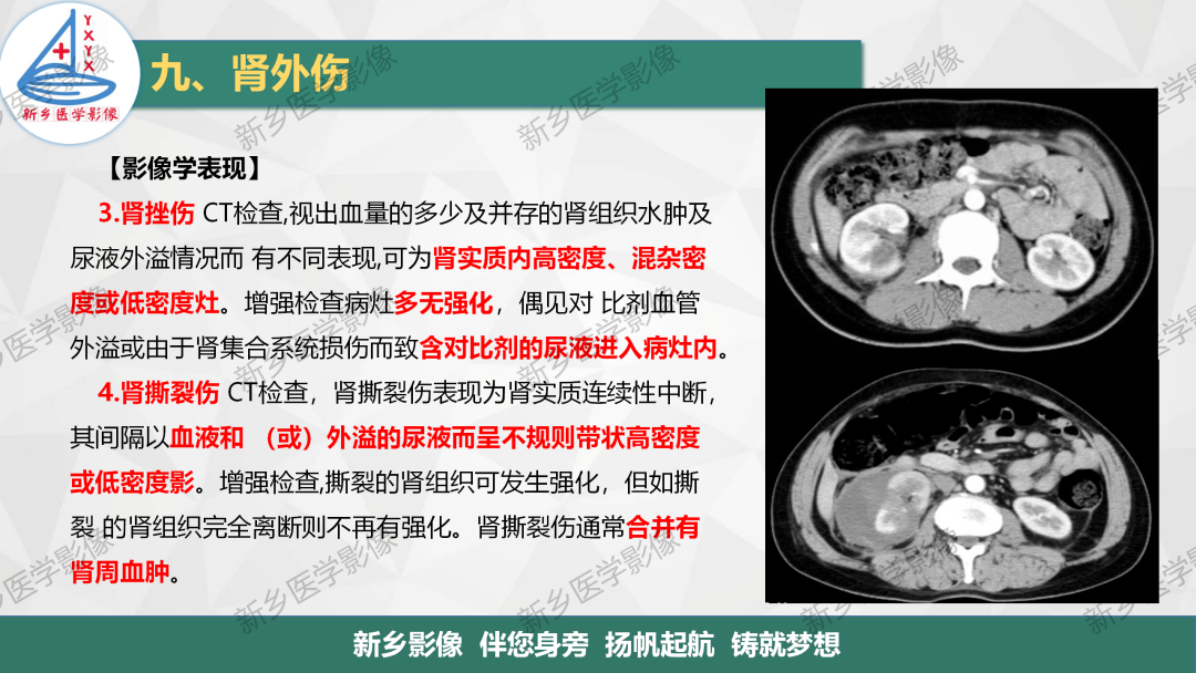 影像PPT - 【PPT】输尿管及膀胱肿瘤分期及肾脏外伤分级-20