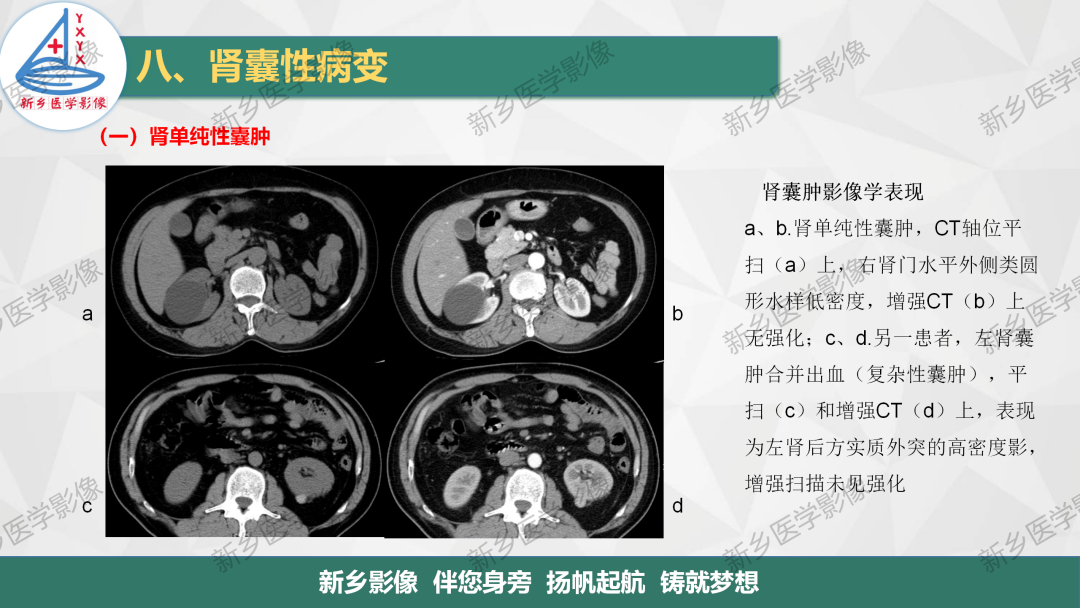 影像PPT - 【PPT】输尿管及膀胱肿瘤分期及肾脏外伤分级-13