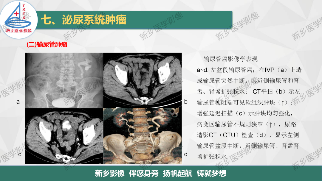 影像PPT - 【PPT】输尿管及膀胱肿瘤分期及肾脏外伤分级-5