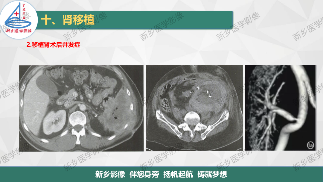 影像PPT - 【PPT】输尿管及膀胱肿瘤分期及肾脏外伤分级-25