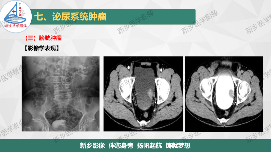 影像PPT - 【PPT】输尿管及膀胱肿瘤分期及肾脏外伤分级-8