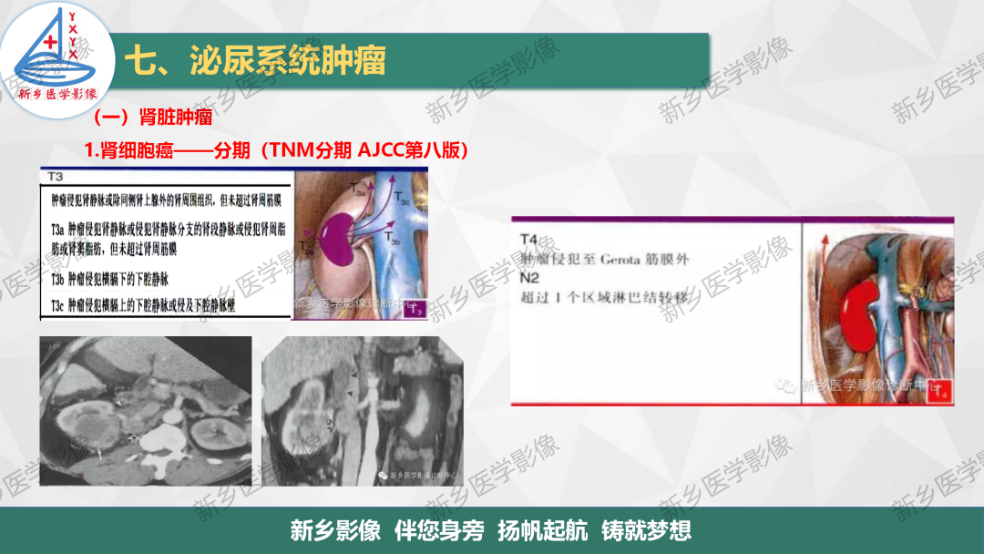 影像PPT - 【PPT】肾脏肿瘤分期 并与肾脏血管平滑肌脂肪瘤鉴别要点-9