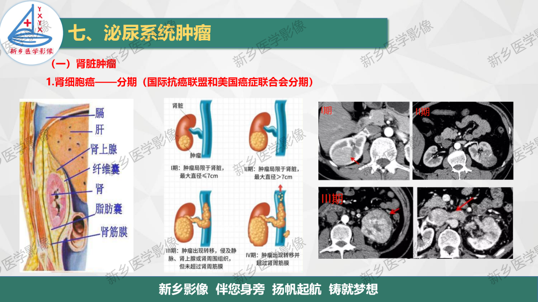 影像PPT - 【PPT】肾脏肿瘤分期 并与肾脏血管平滑肌脂肪瘤鉴别要点-6