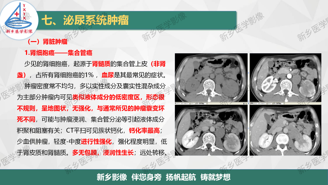 影像PPT - 【PPT】肾脏肿瘤分期 并与肾脏血管平滑肌脂肪瘤鉴别要点-14