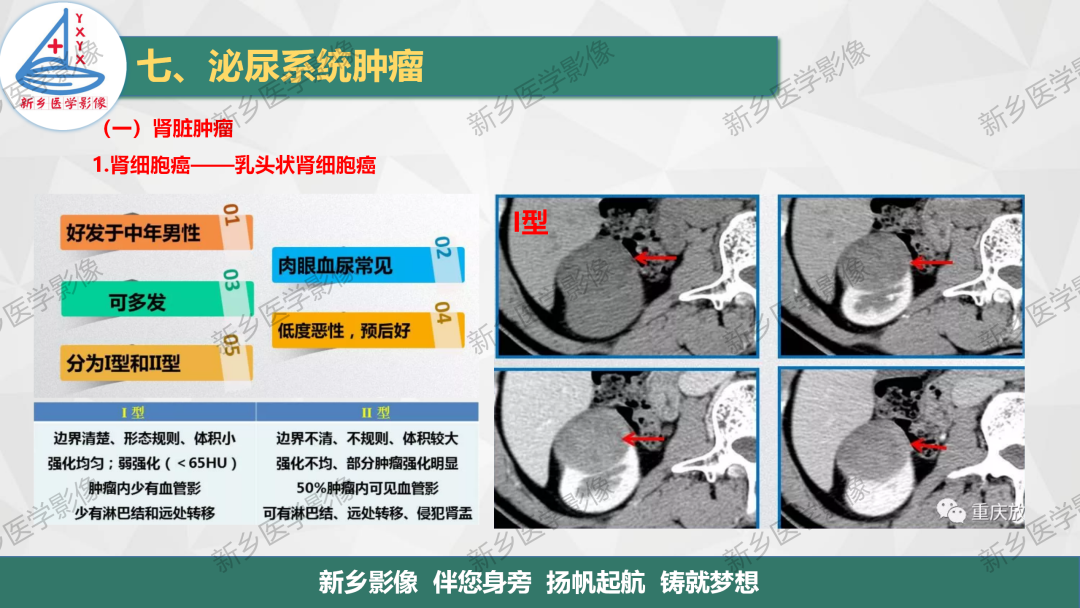 影像PPT - 【PPT】肾脏肿瘤分期 并与肾脏血管平滑肌脂肪瘤鉴别要点-11