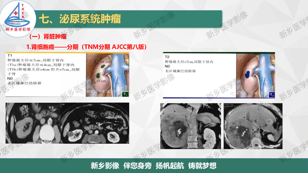 影像PPT - 【PPT】肾脏肿瘤分期 并与肾脏血管平滑肌脂肪瘤鉴别要点-8