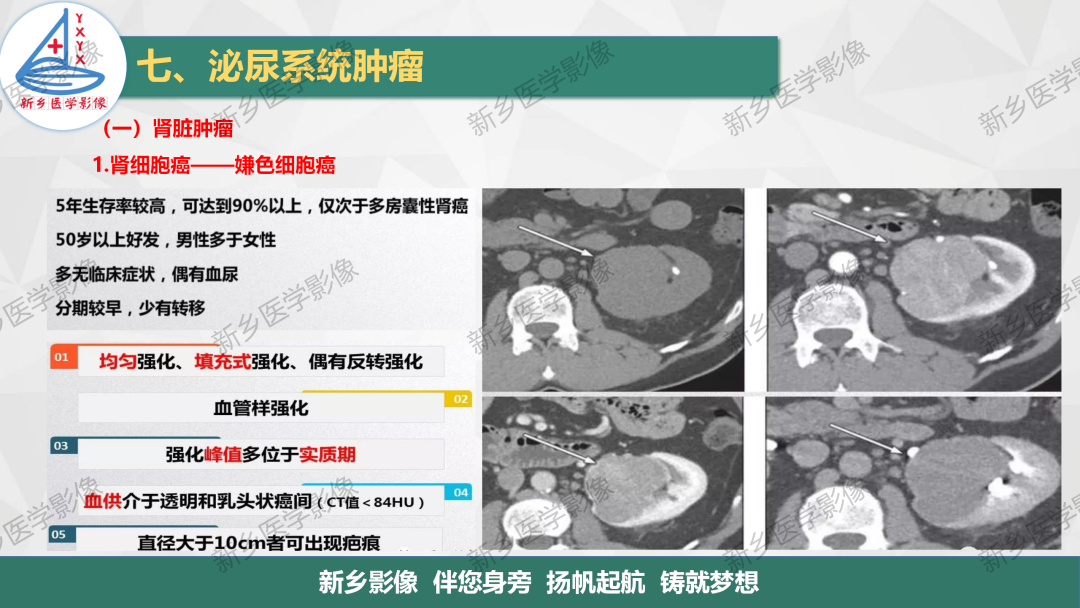 影像PPT - 【PPT】肾脏肿瘤分期 并与肾脏血管平滑肌脂肪瘤鉴别要点-13