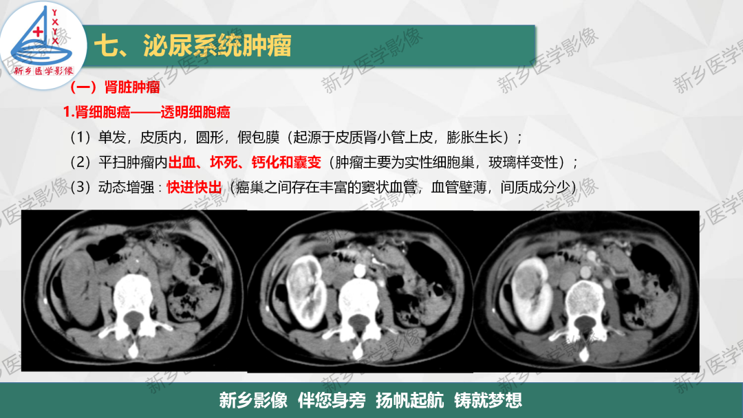 影像PPT - 【PPT】肾脏肿瘤分期 并与肾脏血管平滑肌脂肪瘤鉴别要点-10