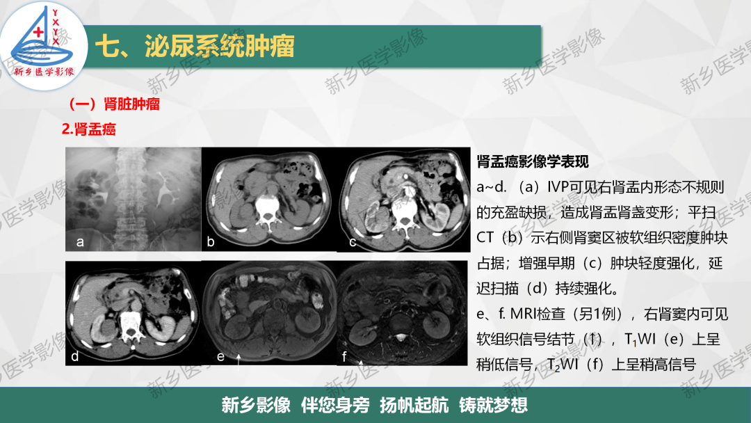 影像PPT - 【PPT】肾脏肿瘤分期 并与肾脏血管平滑肌脂肪瘤鉴别要点-18