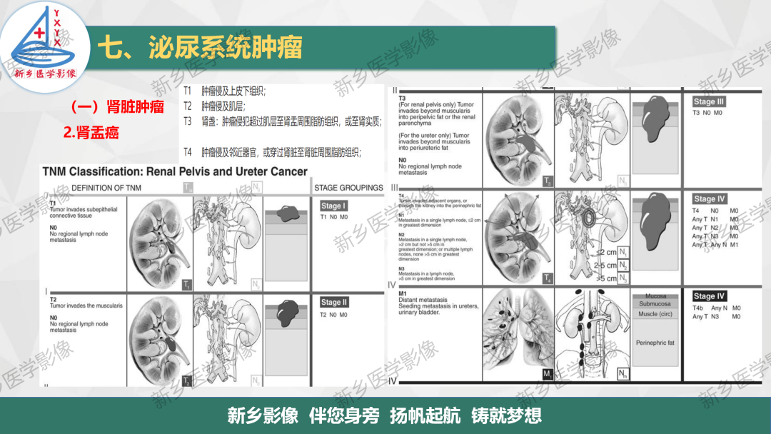 影像PPT - 【PPT】肾脏肿瘤分期 并与肾脏血管平滑肌脂肪瘤鉴别要点-19