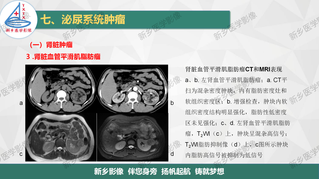 影像PPT - 【PPT】肾脏肿瘤分期 并与肾脏血管平滑肌脂肪瘤鉴别要点-22