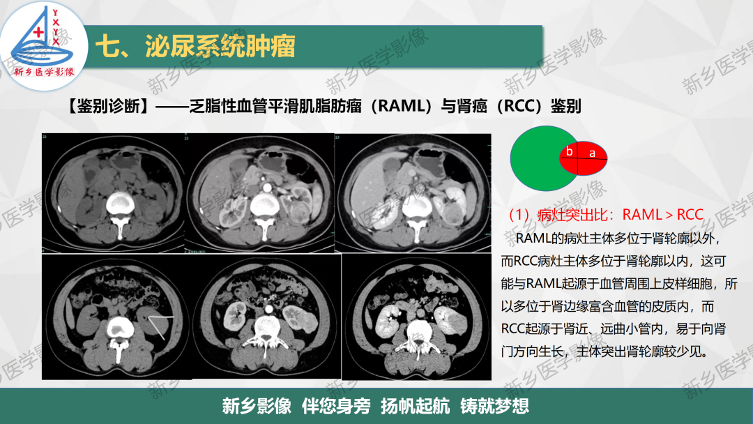 影像PPT - 【PPT】肾脏肿瘤分期 并与肾脏血管平滑肌脂肪瘤鉴别要点-23